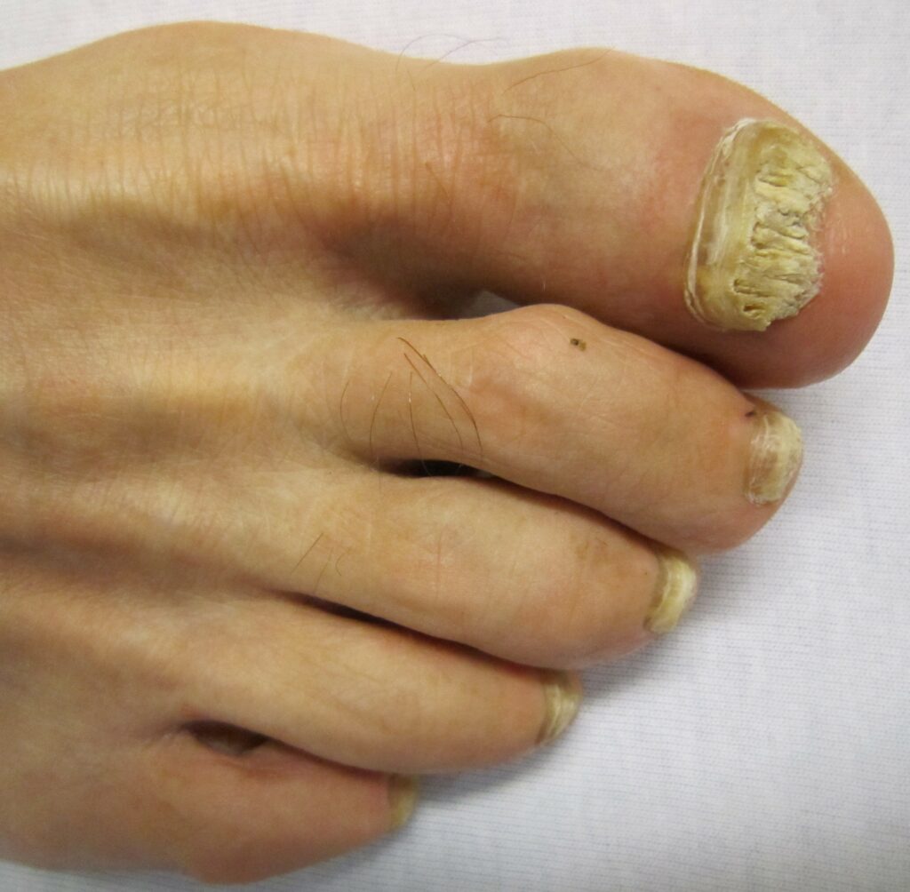 Common Nail Conditions | Hampshire Cure Fungal Nail Clinic