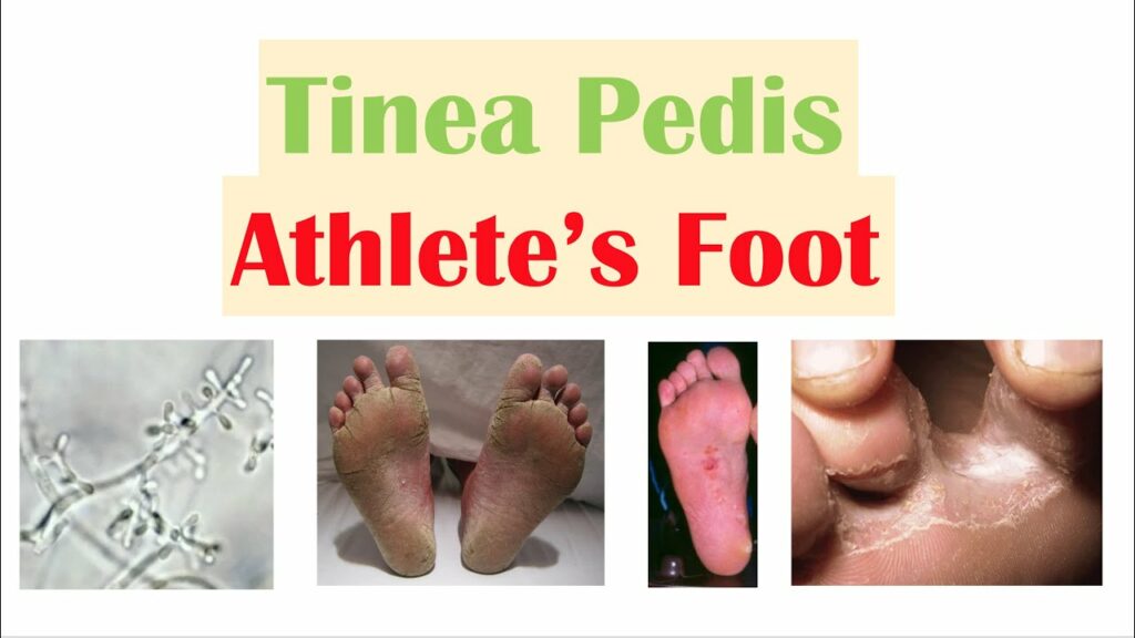 Athlete's Foot/Tinea Pedis - Heather Crawford DPM